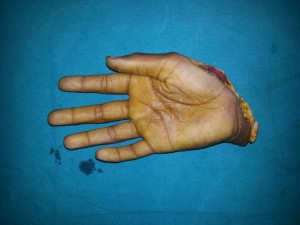 brachial plexus surgery in Nashik WRIST ARTHROSCOPY SURGERY IN NASHIK