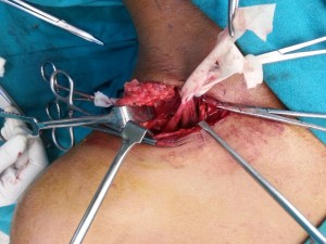 Brachial Plexus Surgery In Nashik Maharashtra | Dr. Amit Varade