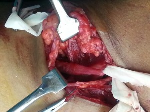 Brachial Plexus Surgery In Nashik Maharashtra | Dr. Amit Varade