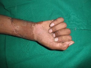 HAND SURGEON IN NASHIK, MAHARASHTRA HAND SURGERY CENTER IN NASHIK – DR.AMIT VARADE