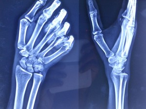 Wrist Arthroscopy Surgeon In Nashik | Dr. Amit Varade