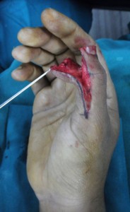 brachial plexus surgery in Nashik