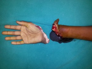 HAND SURGEON IN NASHIK, MAHARASHTRA HAND SURGERY CENTER IN NASHIK – DR.AMIT VARADE