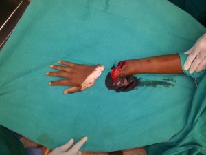 HAND SURGEON IN NASHIK, MAHARASHTRA HAND SURGERY CENTER IN NASHIK – DR.AMIT VARADE