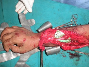 hand surgery center in Nashik