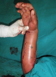 hand surgery center in Nashik