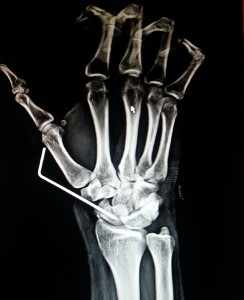 Wrist Arthroscopy Surgeon In Nashik | Dr. Amit Varade