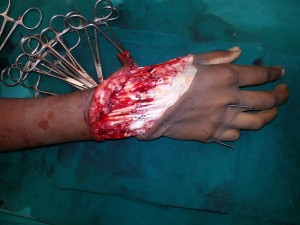 HAND SURGEON IN NASHIK, MAHARASHTRA HAND SURGERY CENTER IN NASHIK – DR.AMIT VARADE