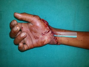 8 HAND SURGEON IN NASHIK, MAHARASHTRA HAND SURGERY CENTER IN NASHIK – DR.AMIT VARADE