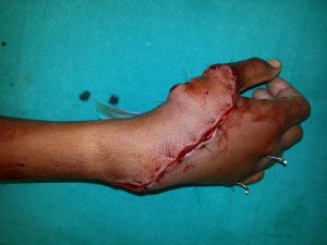 HAND SURGEON IN NASHIK, MAHARASHTRA HAND SURGERY CENTER IN NASHIK – DR.AMIT VARADE