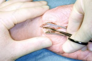 Carperal tunnel surgery in nashik