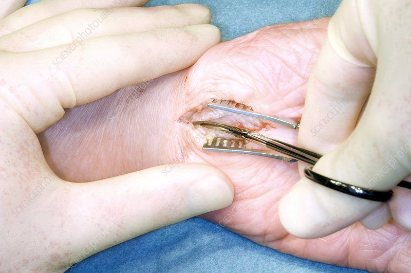 Carperal tunnel surgery in nashik